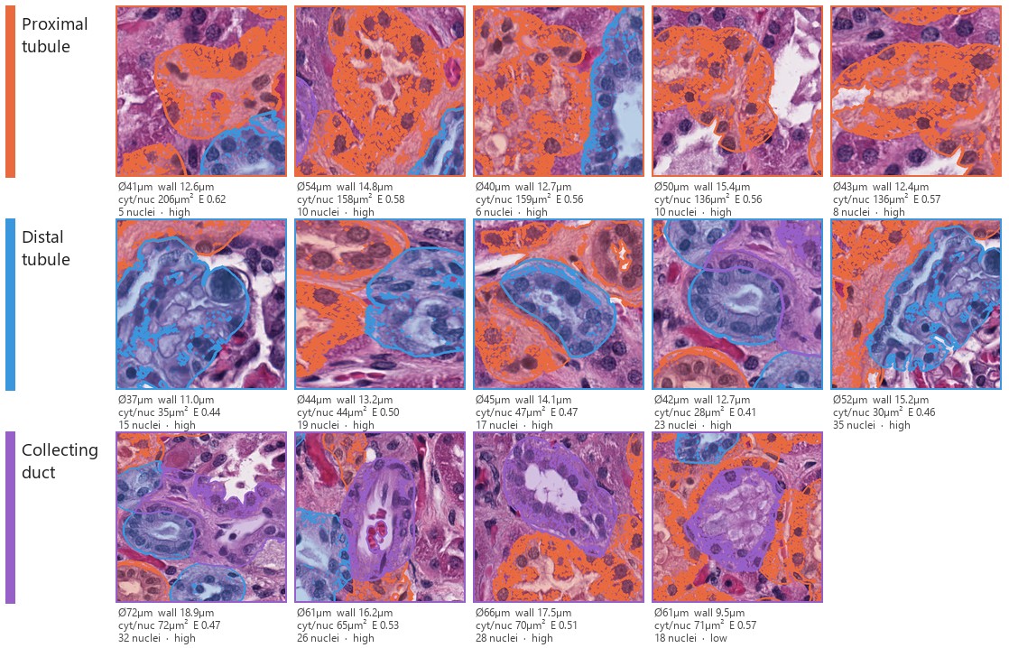 Highest-confidence tubule exemplars by class with the morphological measurements behind each call